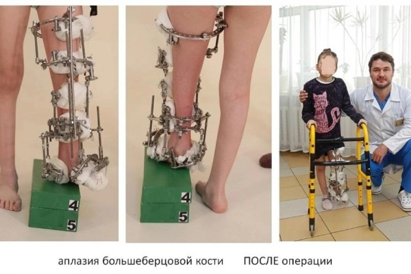В Кургане врачи Илизаровского центра спасли ребёнка от ампутации ноги В Кургане врачи Илизаровского центра спасли ребёнка от ампутации ноги