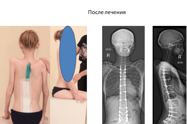 Курганские врачи выпрямили пациентку из Новосибирска