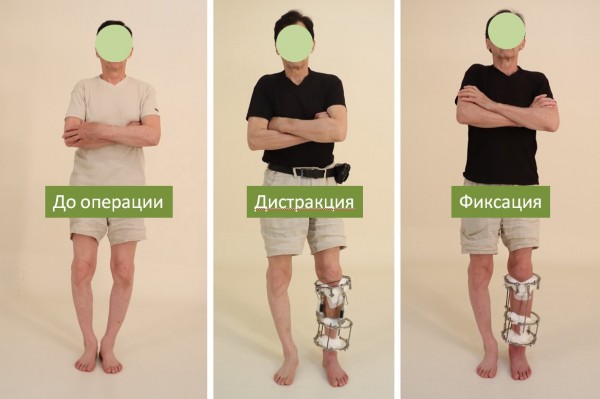 Врачи курганского Центра Илизарова прооперировали пациента революционными методами