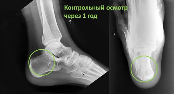 В Кургане врачи Центра Илизарова спасли стопу молодого атлета 