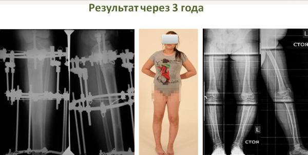 Якутка завершила своё лечение в Центре Илизарова в Кургане спустя 10 лет Якутка завершила своё лечение в Центре Илизарова в Кургане спустя 10 лет