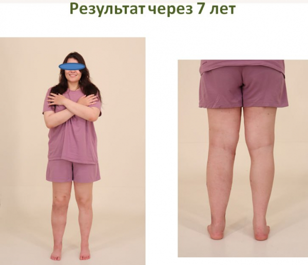Якутка завершила своё лечение в Центре Илизарова в Кургане спустя 10 лет Якутка завершила своё лечение в Центре Илизарова в Кургане спустя 10 лет